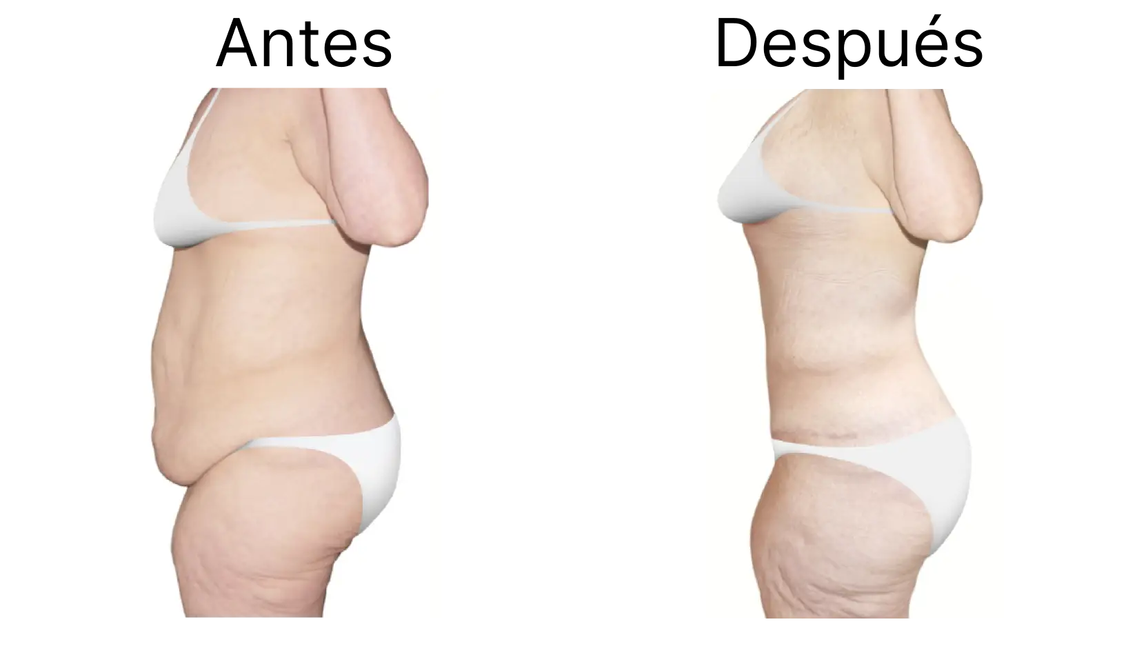 Abdominoplastia 2