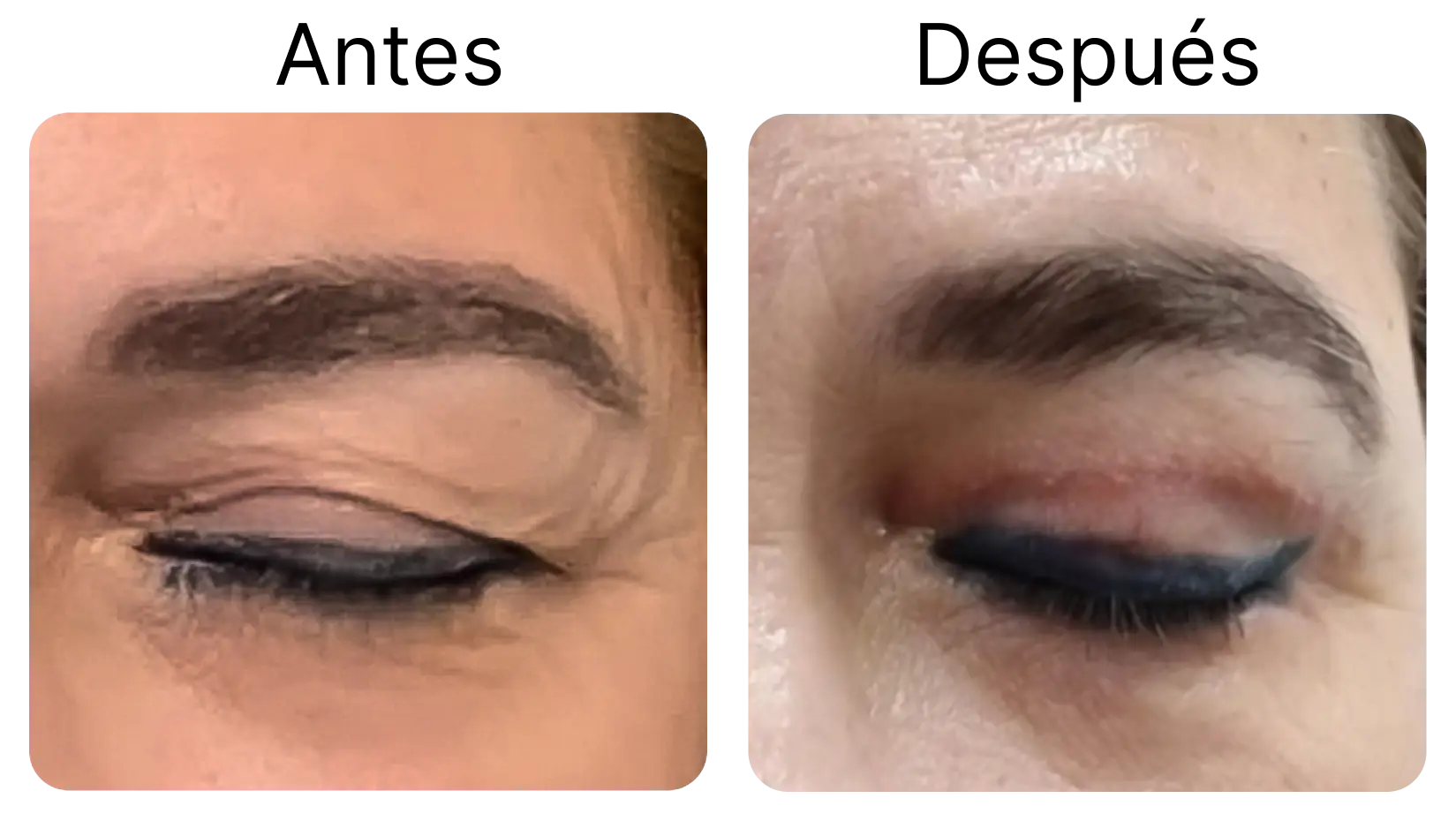 Blefaroplastia 1