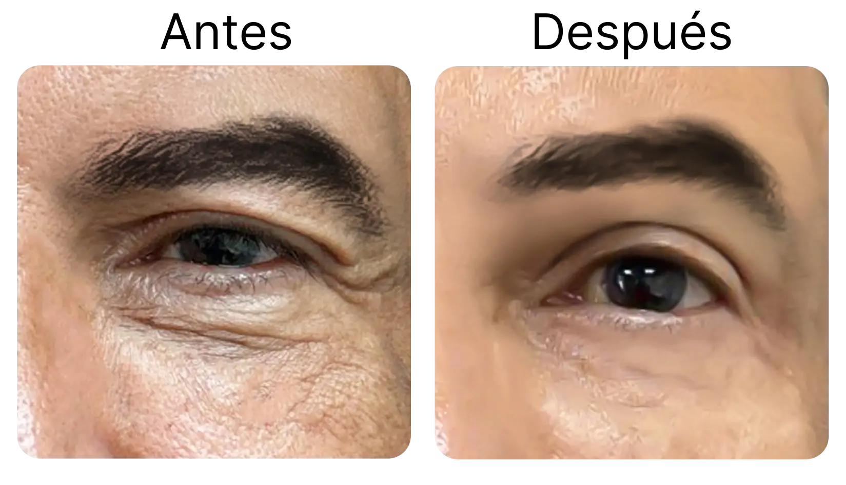 Blefaroplastia 2