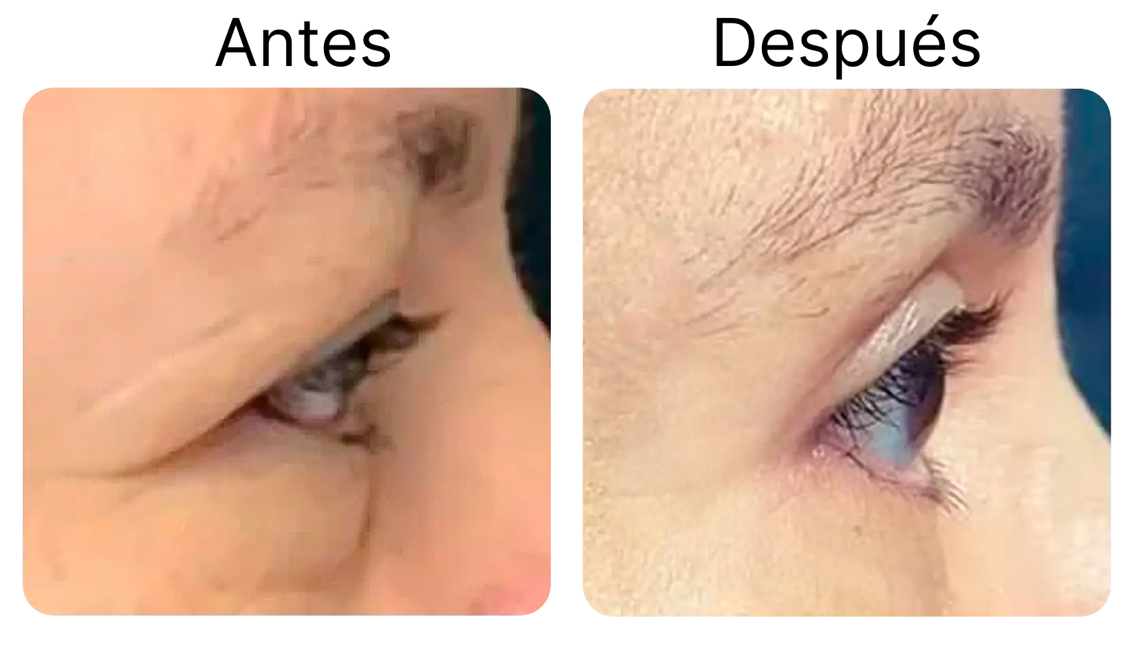 Blefaroplastia 3