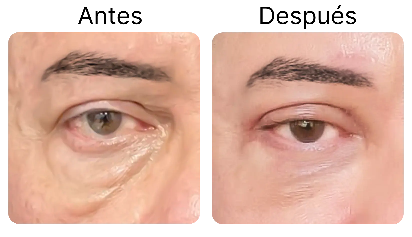 Blefaroplastia 4